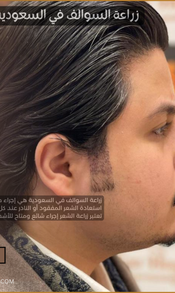 زراعة السوالف في السعودية