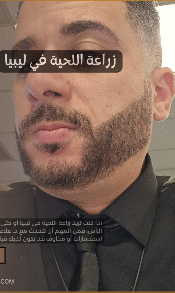 زراعة اللحية في ليبيا