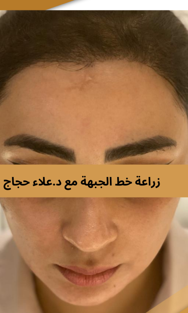 زراعة الشعر للنساء