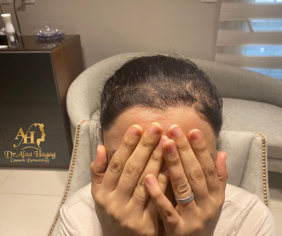 زراعة الشعر للنساء