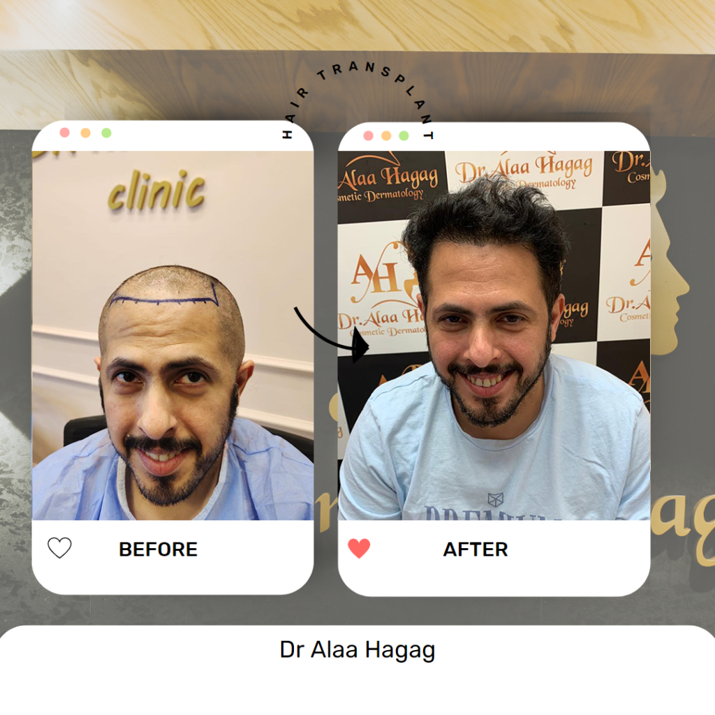 طرق زراعة الشعر الحديثة