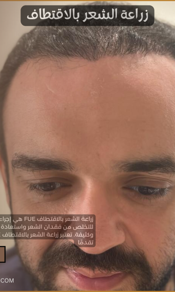 زراعة الشعر بالاقتطاف
