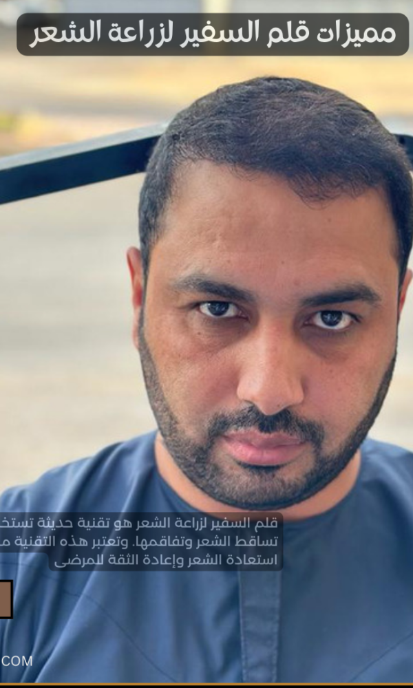 قلم السفير لزراعة الشعر