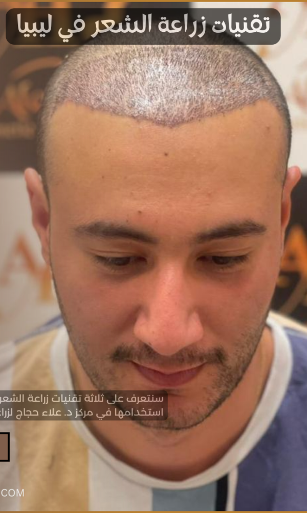 تقنيات زراعة الشعر في ليبيا