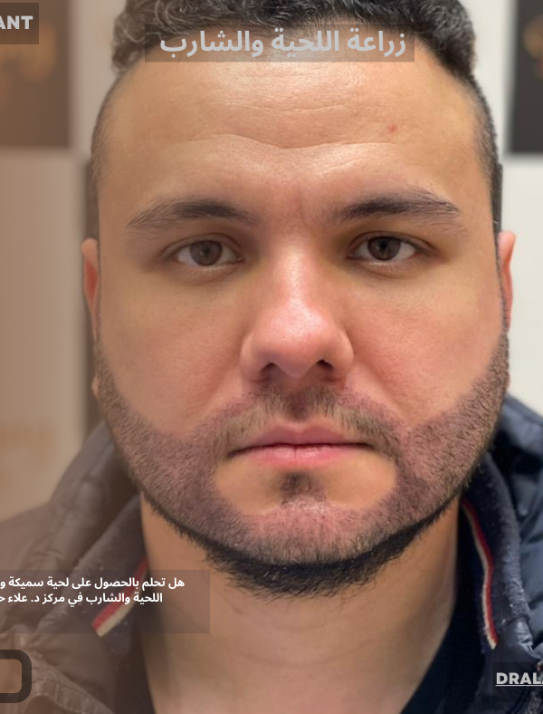 زراعة اللحية والشارب