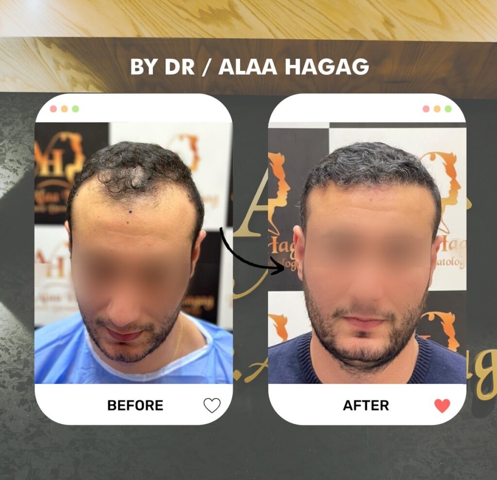 طرق زراعة الشعر الحديثة