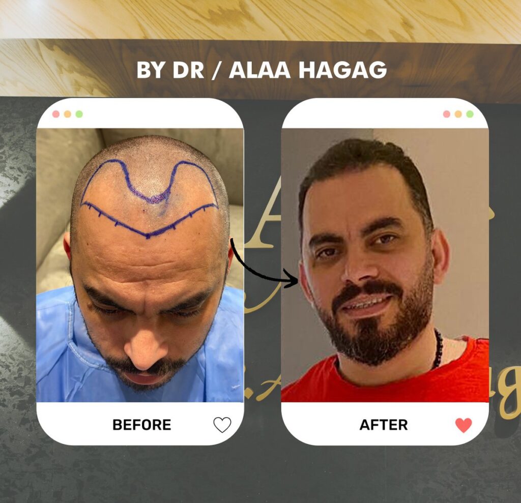 طرق زراعة الشعر الحديثة
