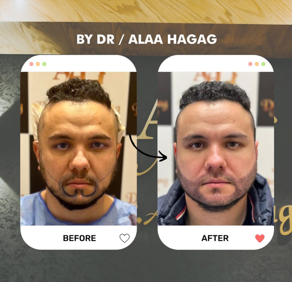 طرق زراعة الشعر الحديثة