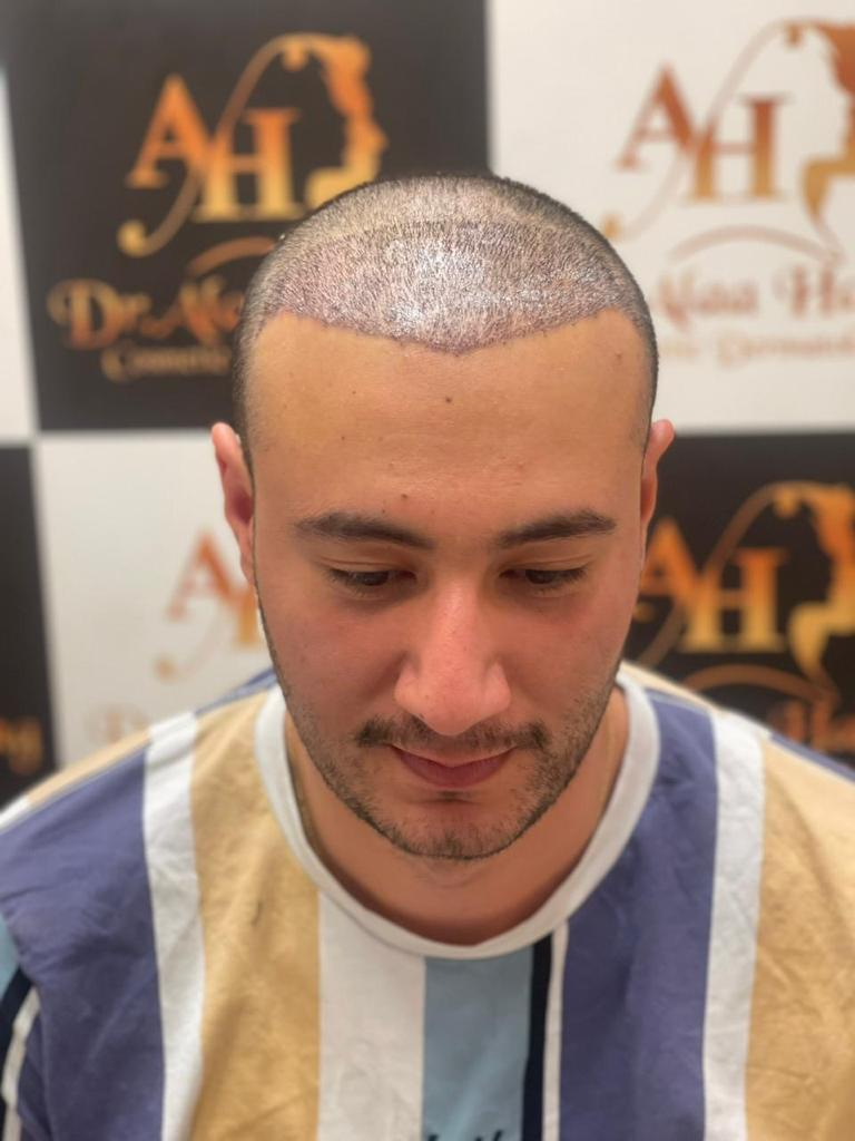 زراعة الشعر بالاقتطاف