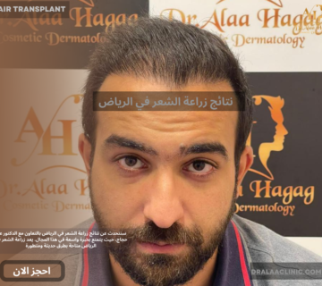 نتائج زراعة الشعر في الرياض