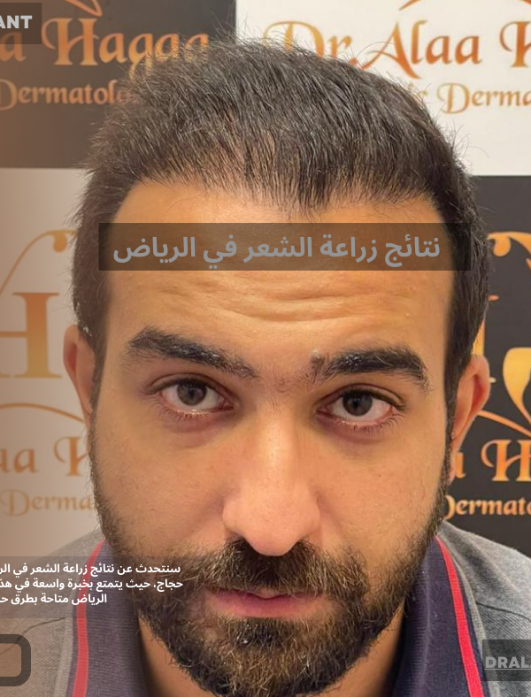 نتائج زراعة الشعر في الرياض