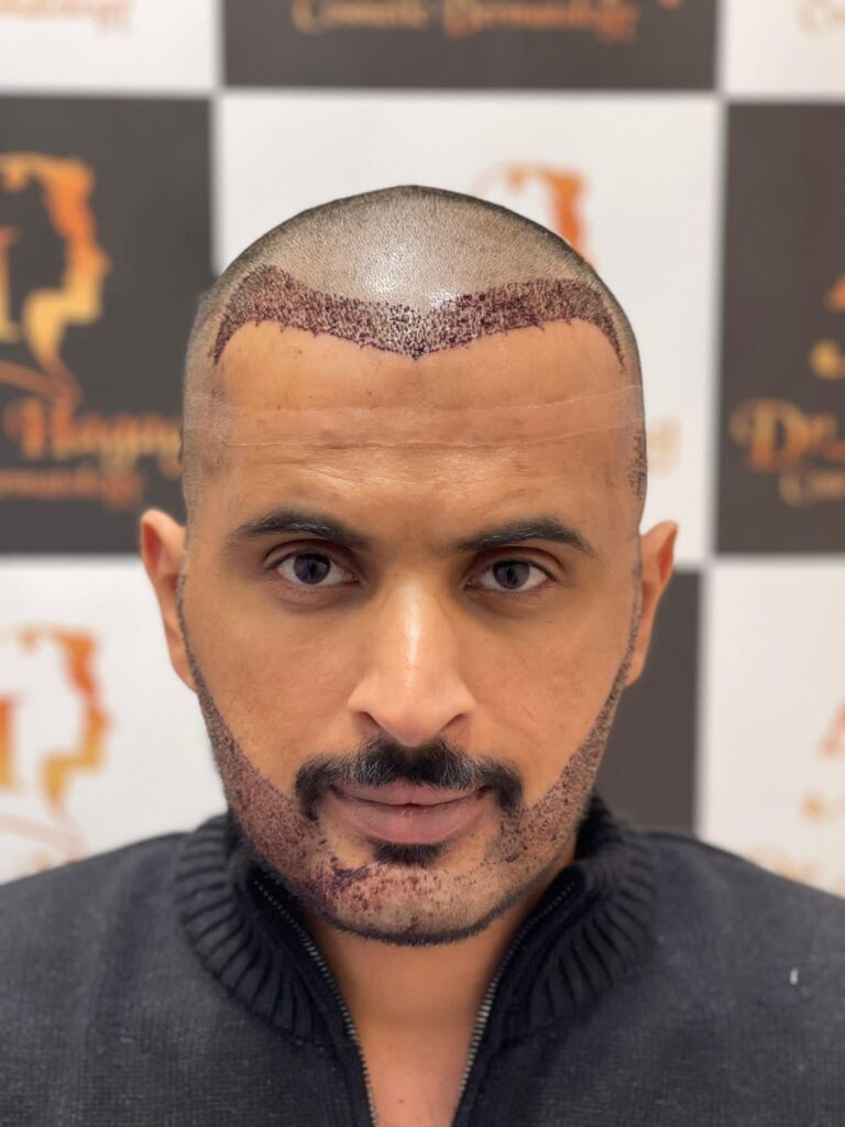 شكل الشعر المزروع بعد شهرين