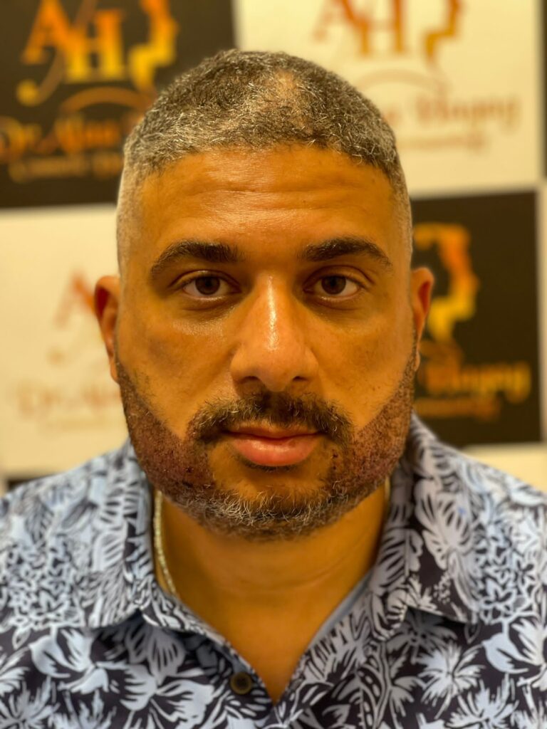 شكل الشعر المزروع بعد شهرين