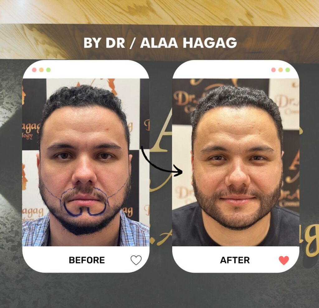 مراكز زراعة الشعر في الرياض