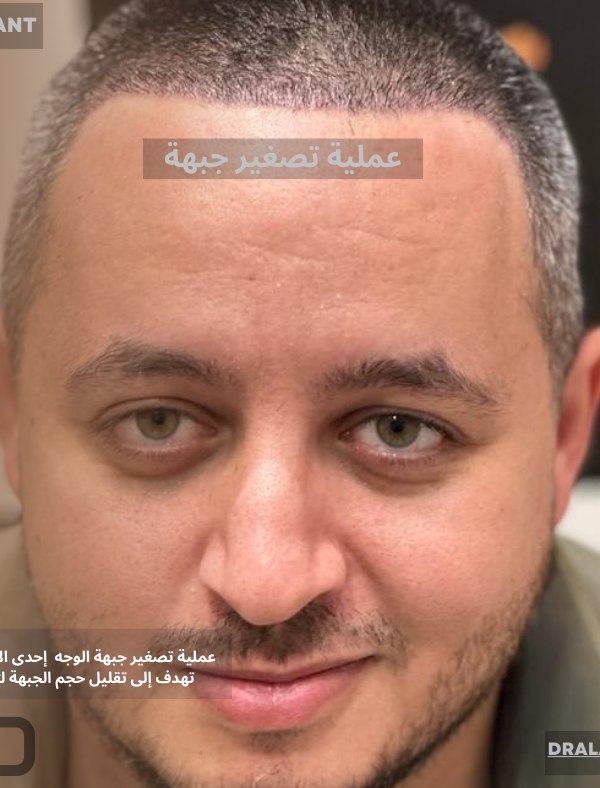 عملية تصغير جبهة