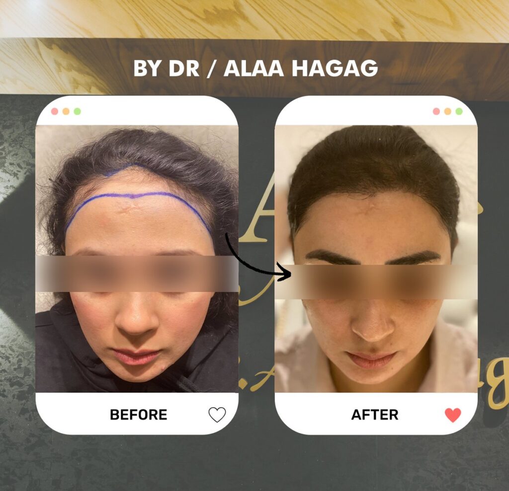زراعة الشعر في الشيخ زايد