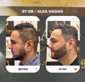 علاج تساقط الشعر في زايد