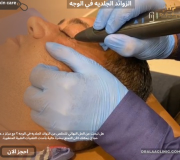 الزوائد الجلديه في الوجه