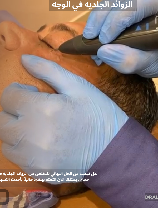 الزوائد الجلديه في الوجه