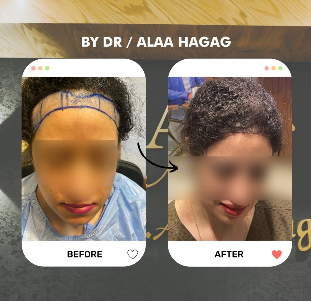 مركز زراعة الشعر في السعودية