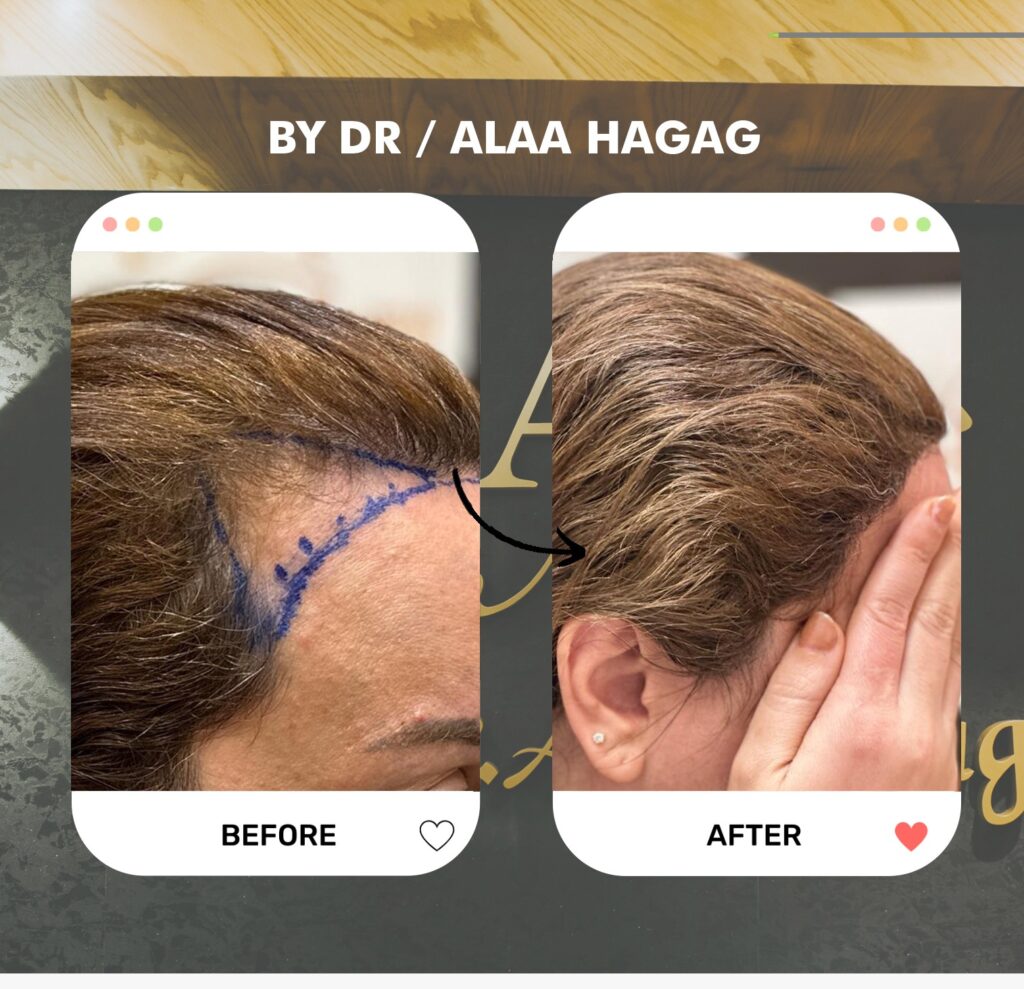 مركز زراعة الشعر في السعودية