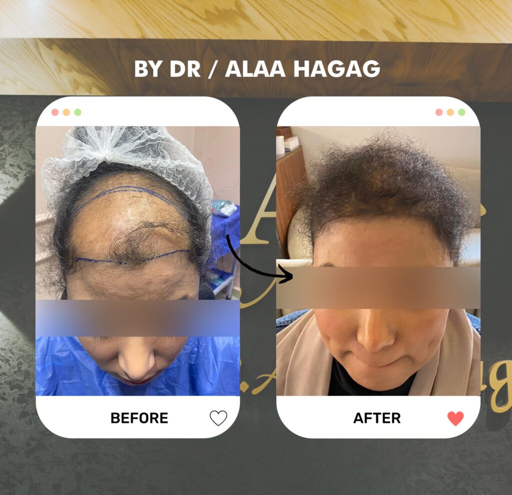 مركز زراعة الشعر في السعودية