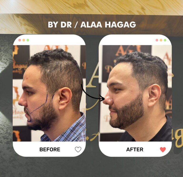 ممنوعات بعد زراعة الشعر