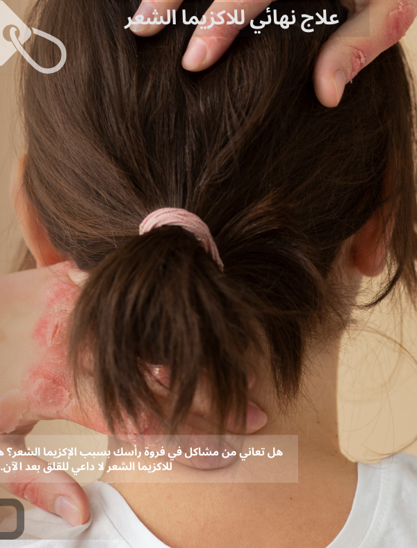 علاج نهائي للاكزيما الشعر