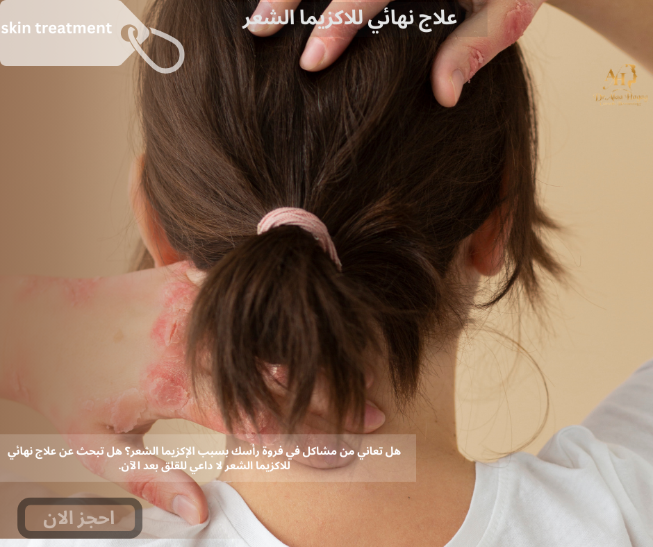 علاج نهائي للاكزيما الشعر