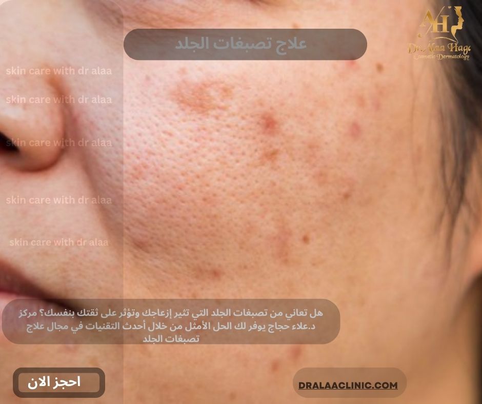 علاج تصبغات الجلد