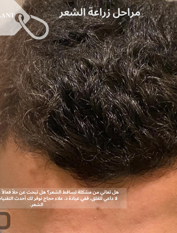 مراحل زراعة الشعر