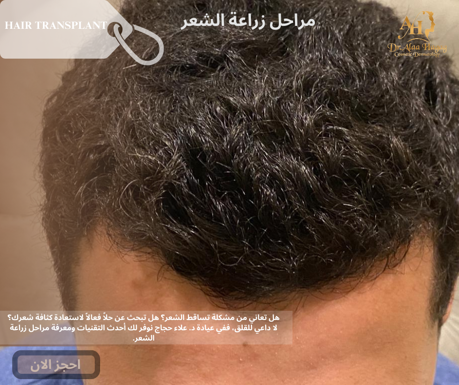 مراحل زراعة الشعر