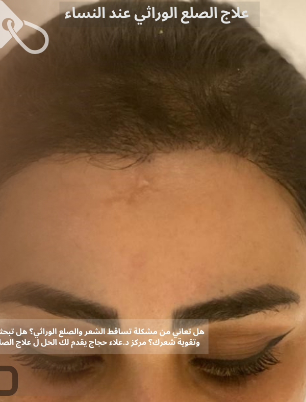 علاج الصلع الوراثي عند النساء