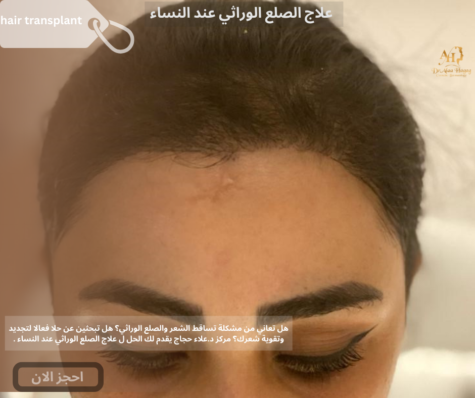 علاج الصلع الوراثي عند النساء