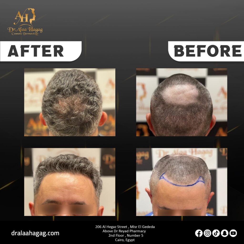 زراعة الشعر في مصر