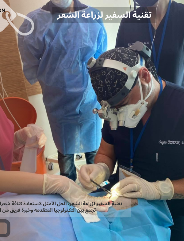تقنية السفير لزراعة الشعر