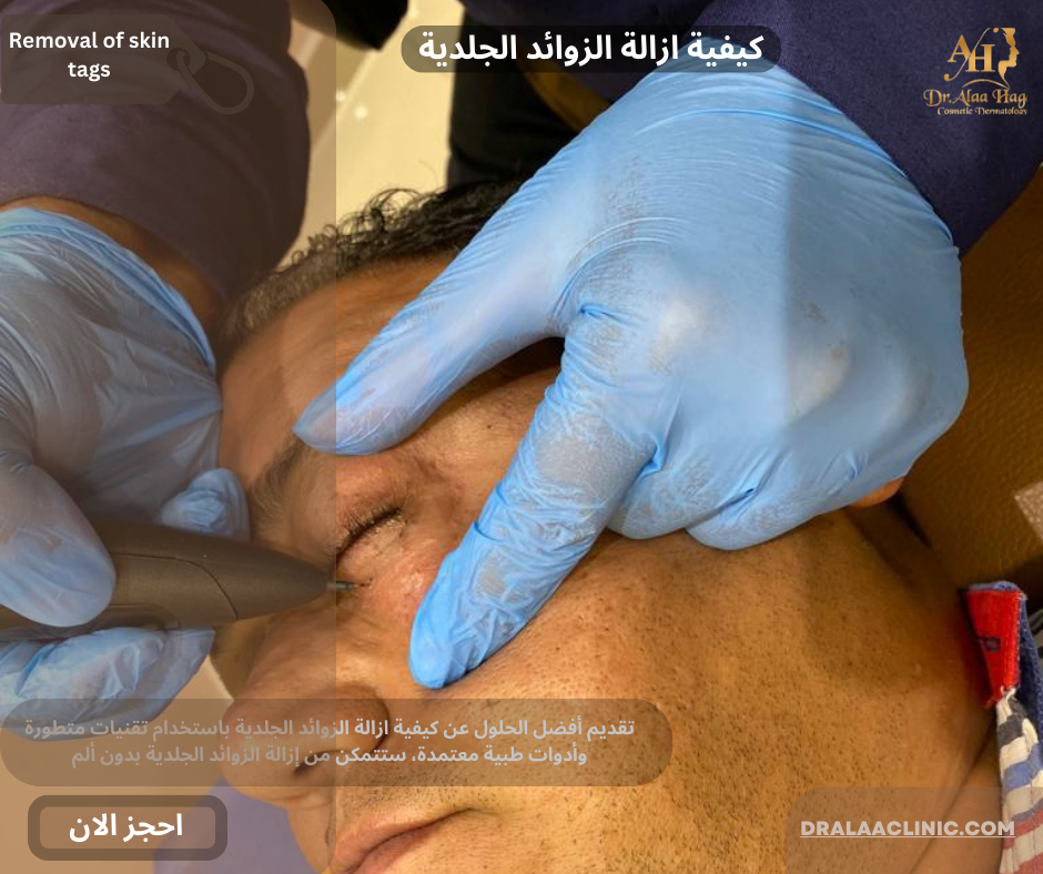 كيفية ازالة الزوائد الجلدية