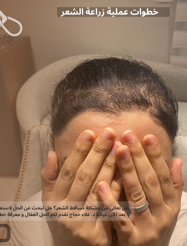 خطوات عملية زراعة الشعر