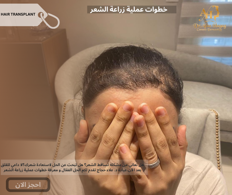 خطوات عملية زراعة الشعر