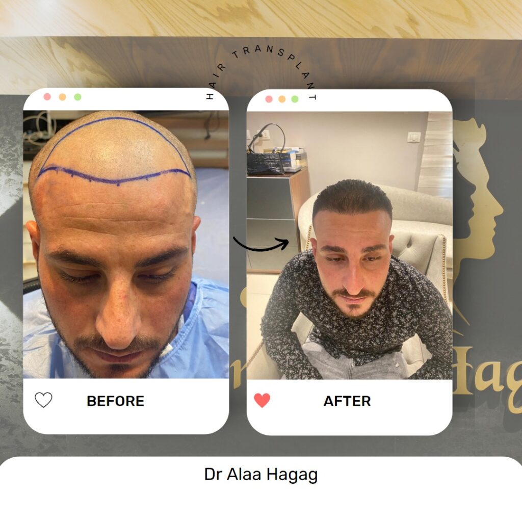 علاج تساقط الشعر للرجال