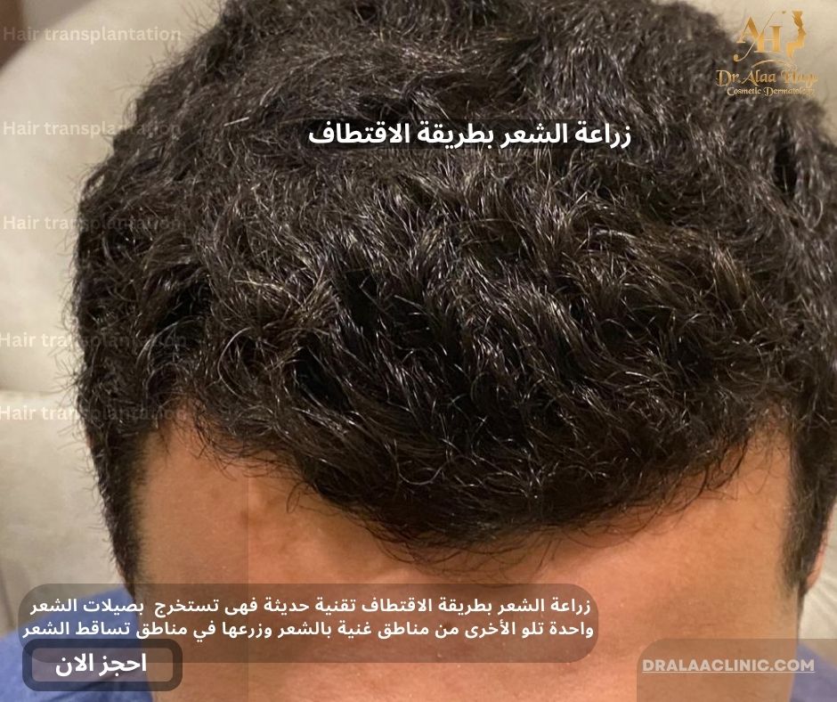 زراعة الشعر بطريقة الاقتطاف