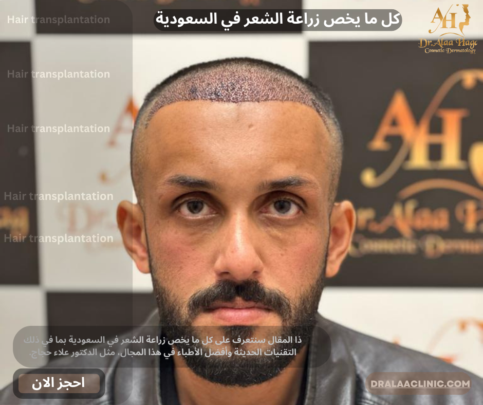 كل ما يخص زراعة الشعر في السعودية