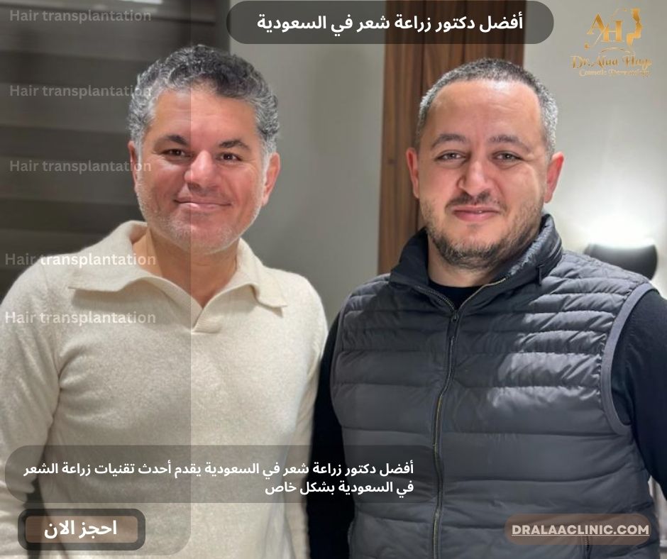 أفضل دكتور زراعة شعر في السعودية