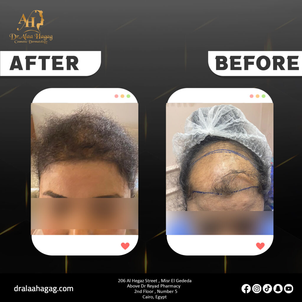 زراعة شعر الجبهة للنساء