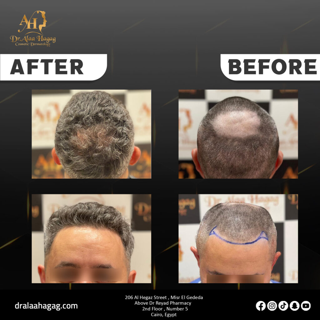 عمليات زرع الشعر في مصر واسعارها