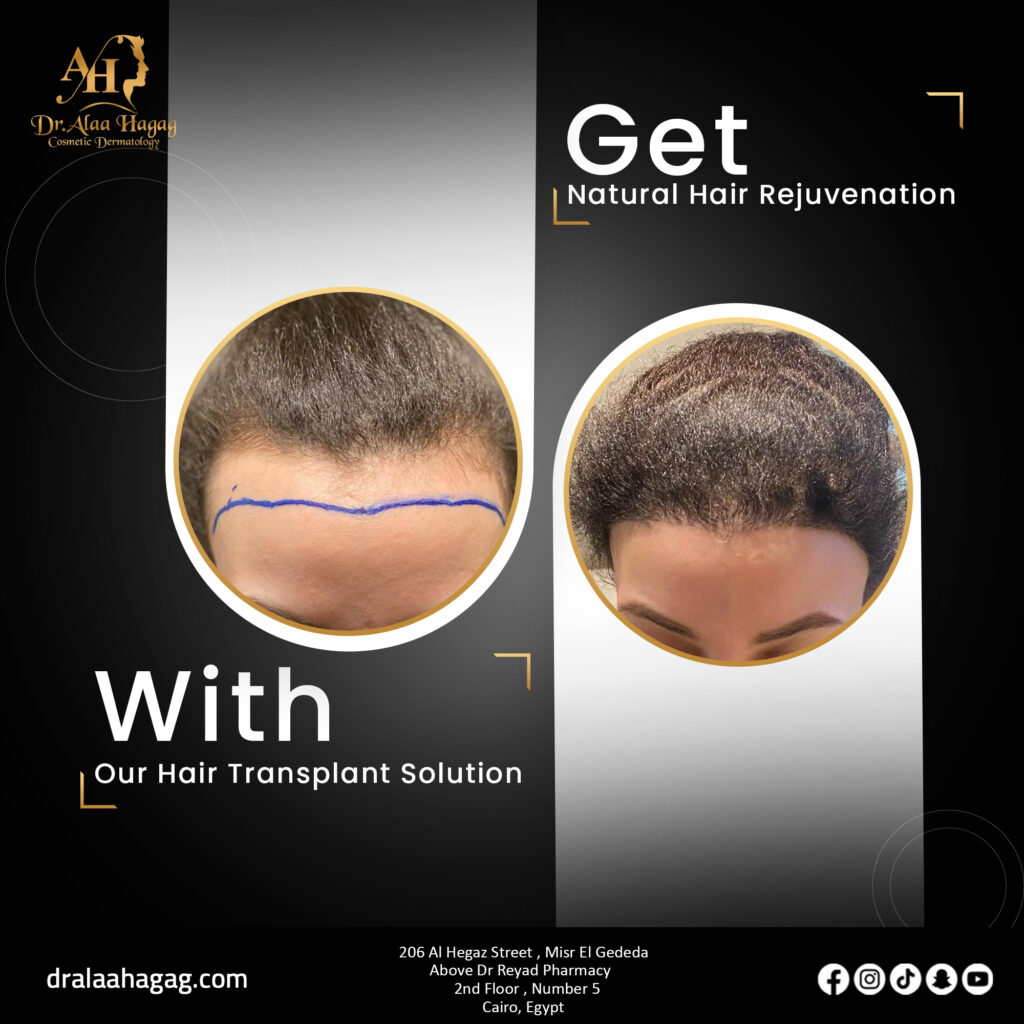 كل ما يخص زراعة الشعر في السعودية