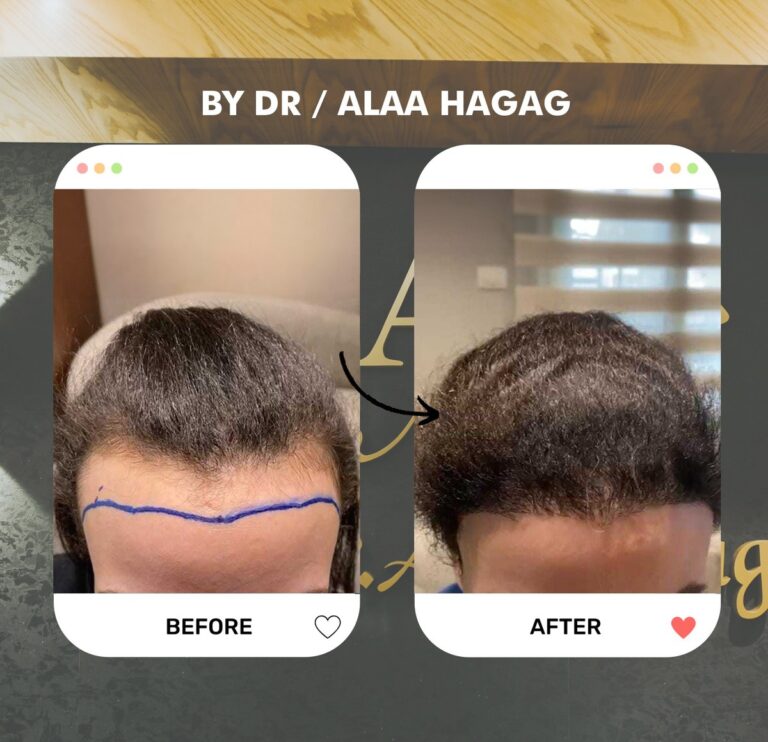 زراعة شعر الجبهة للنساء