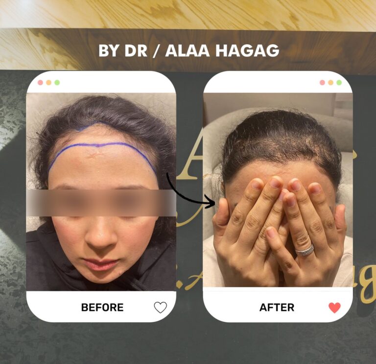 زراعة شعر الجبهة للنساء