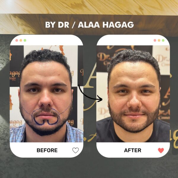 زراعه شعر الدوجلاس