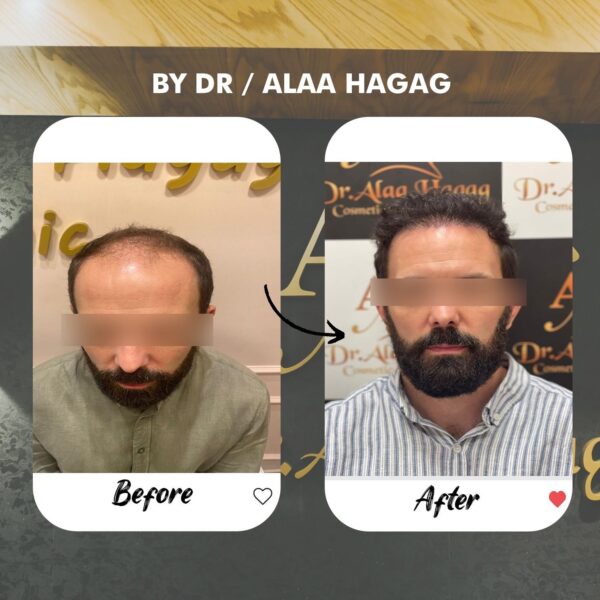 البلازما لتكثيف الشعر